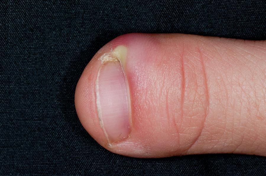 Paronychia Infection Of The Thumb Photograph by Dr P. Marazzi/science ...