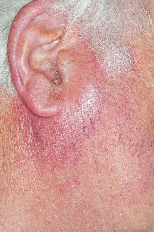 Parotid Gland Enlargement Photograph By Dr P Marazziscience Photo Library 1295