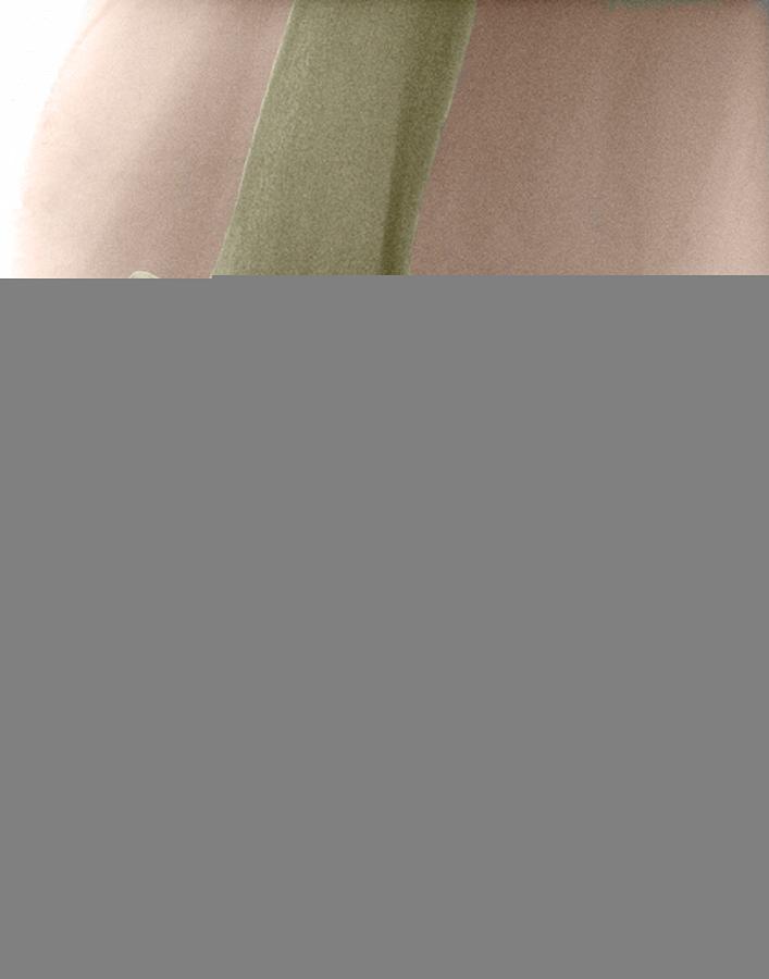 Knee Replacement Photograph - Partial Knee Replacement by Science Photo Library