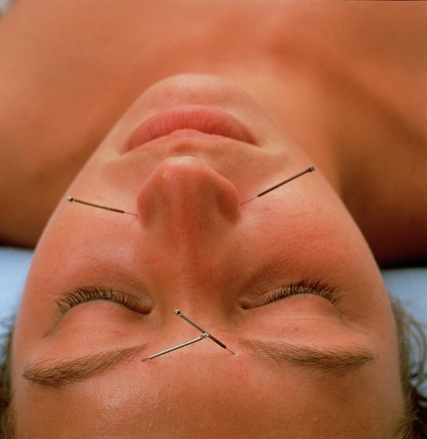 Wellbeing Photograph - Patient Undergoing Acupuncture Treatment by Tim Malyon & Paul Biddle/science Photo Library