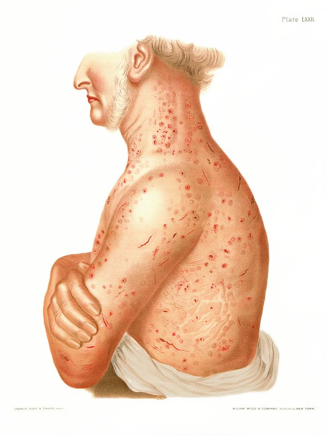 Pediculosis Corporis Photograph By Us National Library Of Medicine