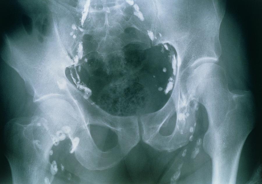 Pelvic Lymph Node Anatomy