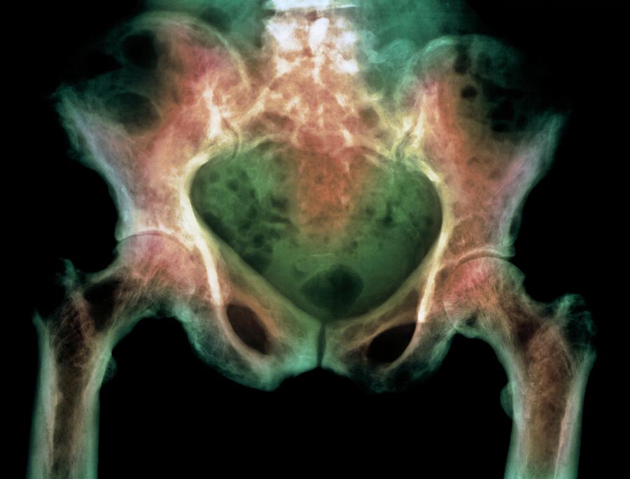 X-ray Photograph - Pelvis In Pagets Disease by Science Photo Library