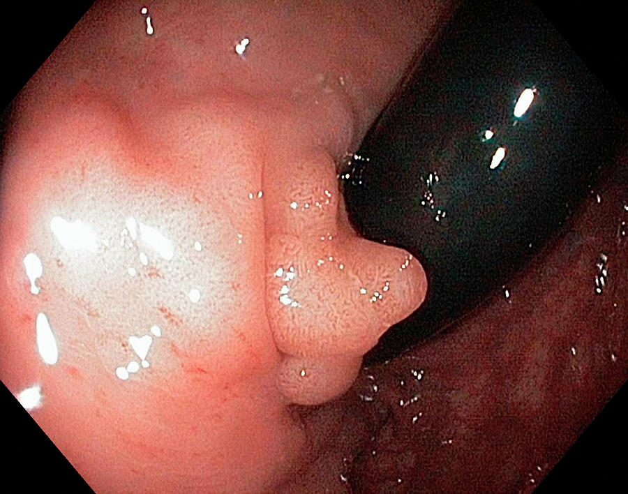 Abnormal Photograph - Perianal Polyp by Gastrolab
