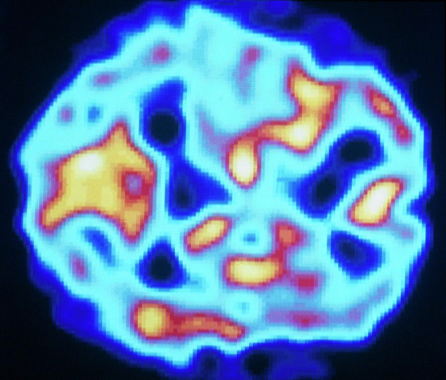 Pet Scan (temporal) Of Carbon Monoxide Poisoning Photograph by Tim Beddow/science Photo Library