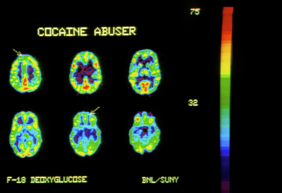 Pet Scan Photograph - Pet Scans Of Brain Of A Cocaine User by Pascal Goetgheluck/science Photo Library