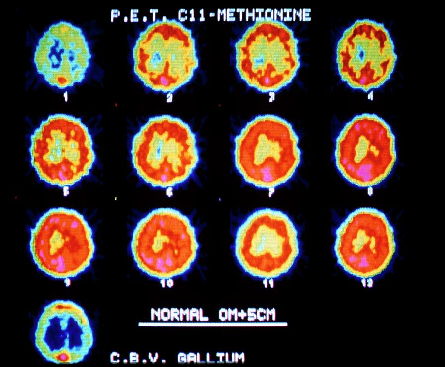 Pet Scans Showing Protein Synthesis In The Brain Photograph by Cnri/science Photo Library