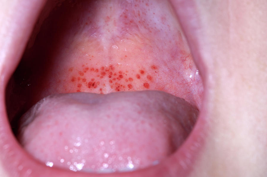 Petechiae On The Palate Photograph By Dr P Marazzi/science Photo Library 