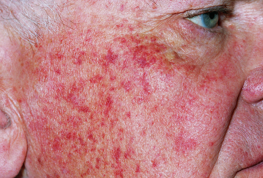 petechial-rash-photograph-by-dr-p-marazzi-science-photo-library