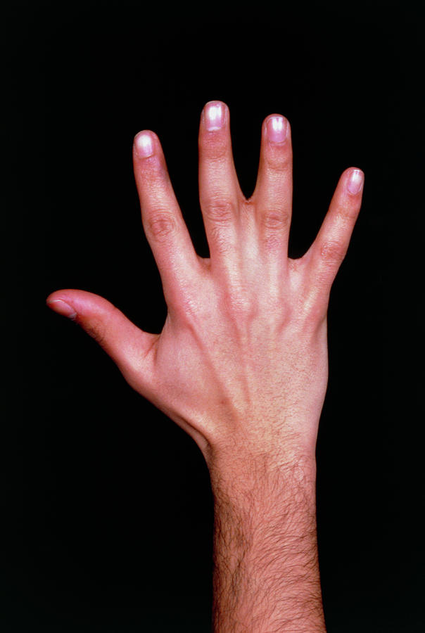 photo-showing-congenital-fusion-of-2-fingers-photograph-by-james