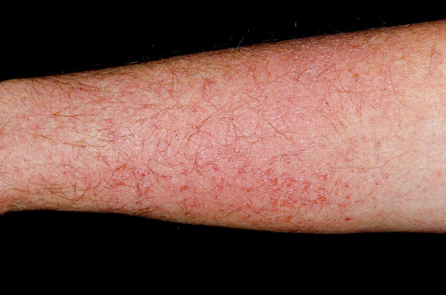 Photosensitive Rash On The Arm Photograph By Dr P Marazzi Science Photo Library