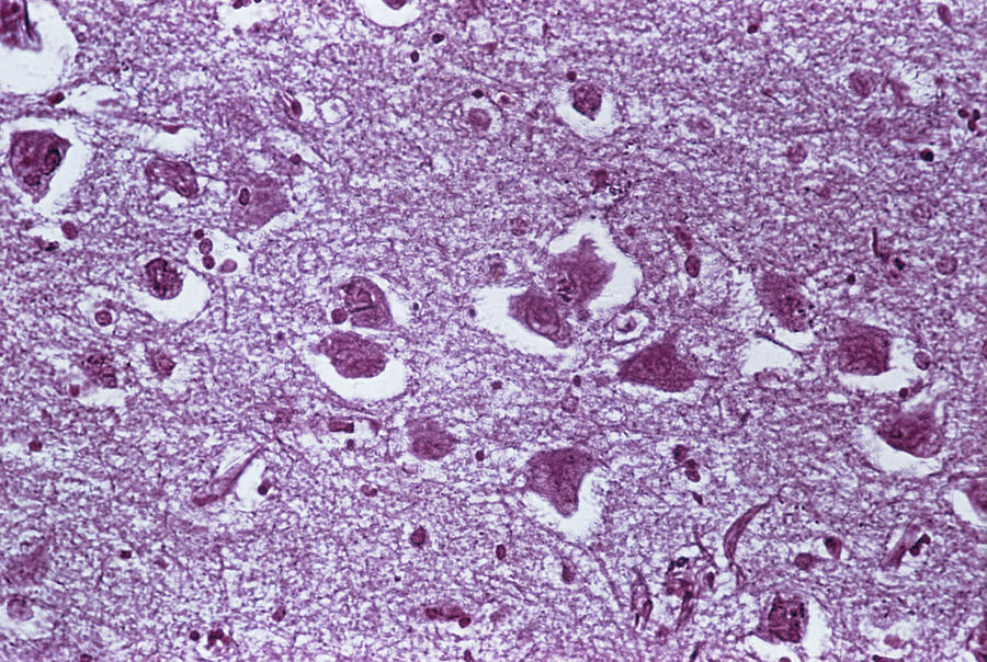 Medicine Photograph - Picks Disease Brain Tissue by Cnri/science Photo Library