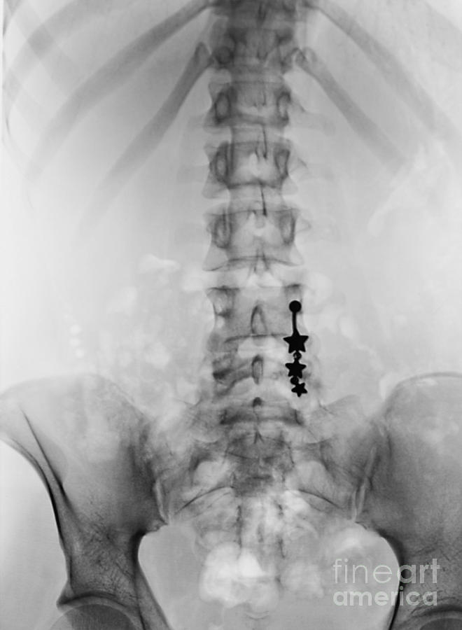 Pierced Navel, X-ray Photograph by Scott Camazine