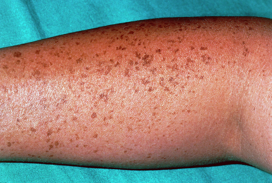 Pigmented Naevi (moles) On The Arm Of A Patient Photograph by Dr P ...