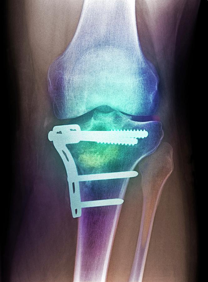 Pinned Broken Knee Photograph by Science Photo Library