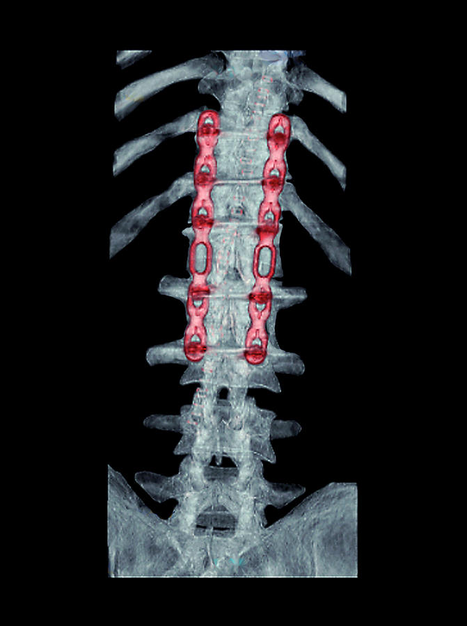 broken vertebrae x ray