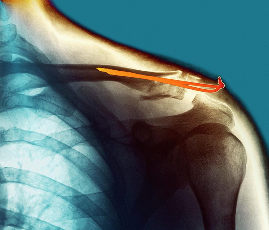 Pinned Collar Bone Fracture Photograph By Zephyrscience Photo Library