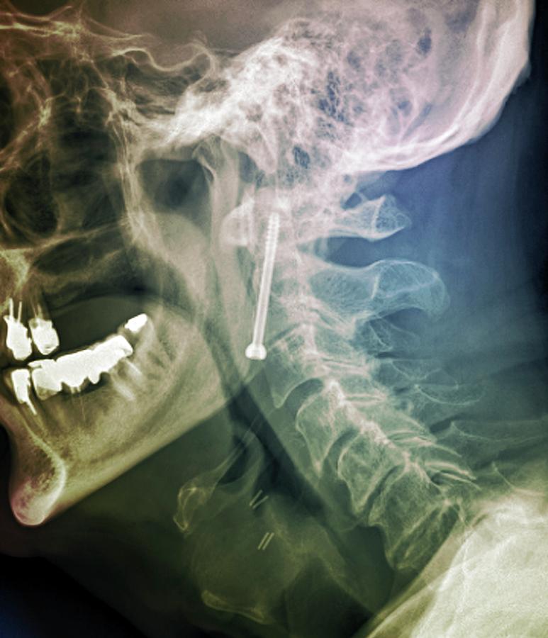Pinned Neck Fracture Photograph by Zephyr/science Photo Library