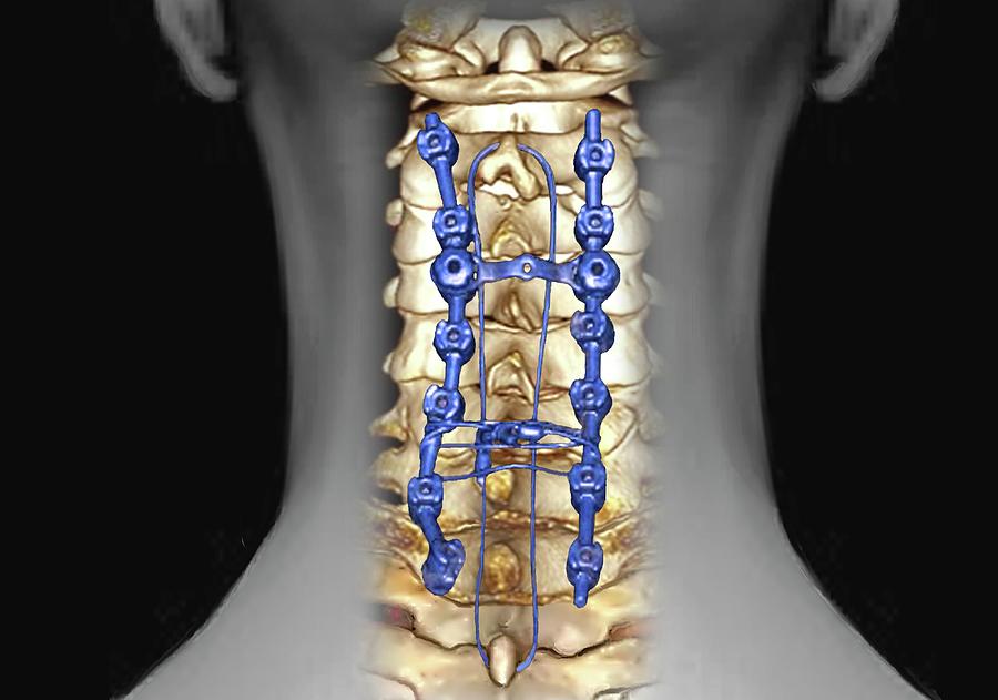 Pinned Neck Vertebrae Photograph by Zephyr/science Photo Library