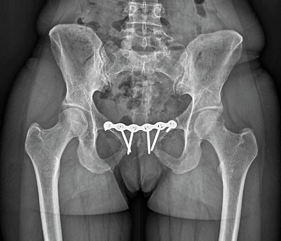 'pinned Pelvic Fracture Photograph by Zephyr/science Photo