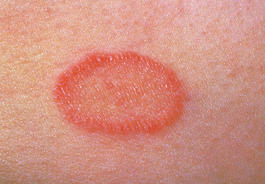 Pityriais Rosea: Close-up Of A Single Lesion Photograph by Dr H.c ...