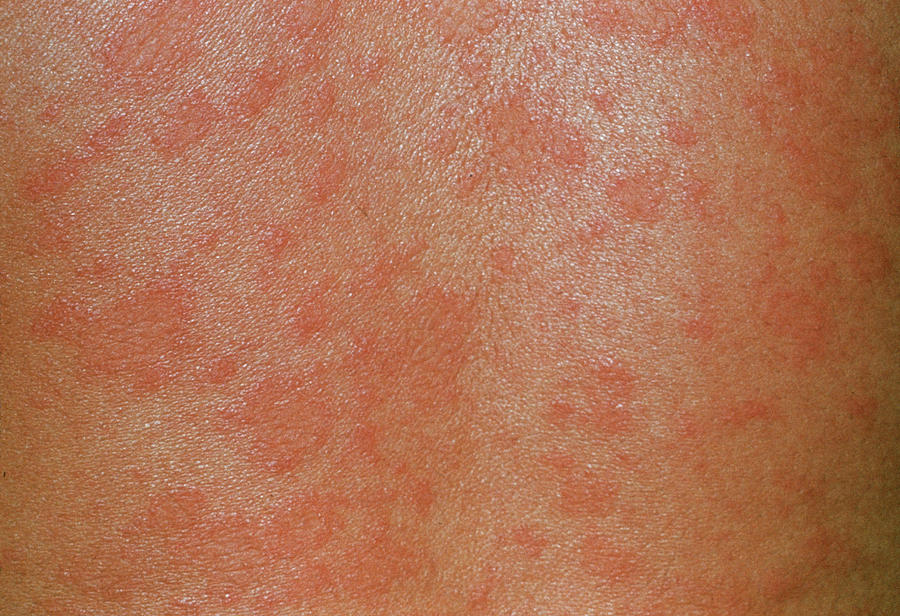Pityriasis Rosea Skin Rash Photograph By Cnriscience Photo Library