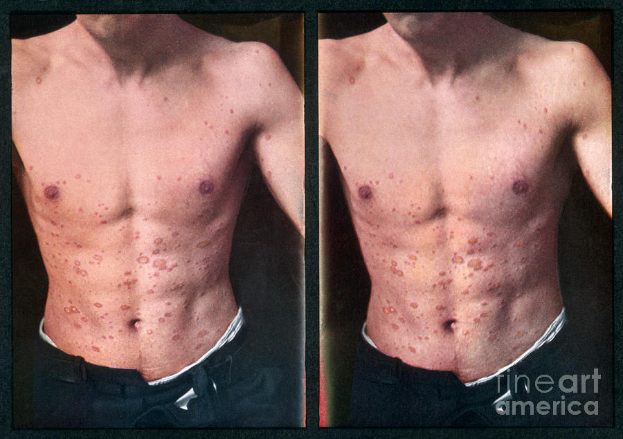 Pityriasis Rosea, Vintage Stereoscopic Photograph by DoubleVision
