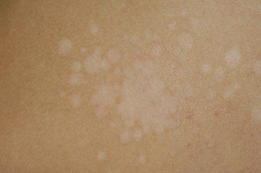 Pityriasis Versicolor Of The Skin Photograph By Dr P Marazziscience