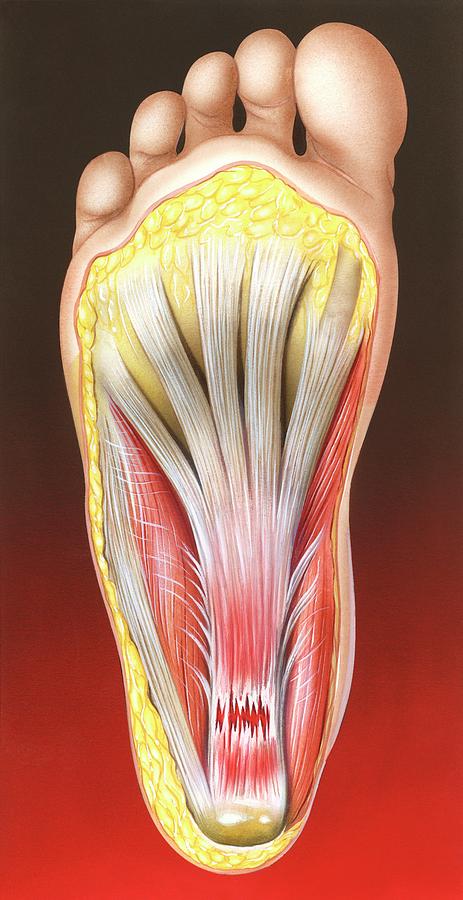 Plantar Fasciitis Photograph by John Bavosi/science Photo Library ...