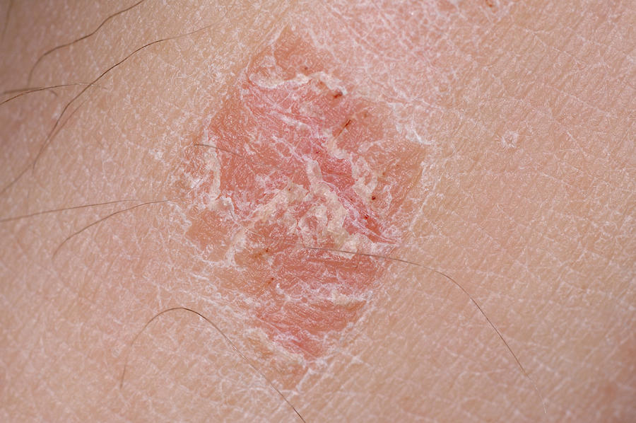 Plaque Psoriasis On Leg Photograph by Martin Shields