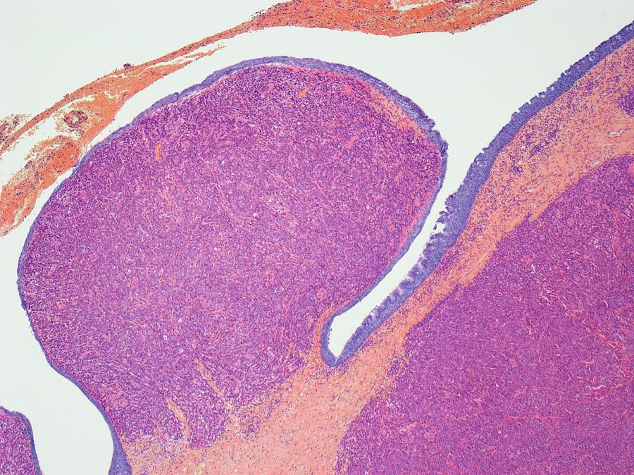 Plasmacytoma Photograph by Steve Gschmeissner