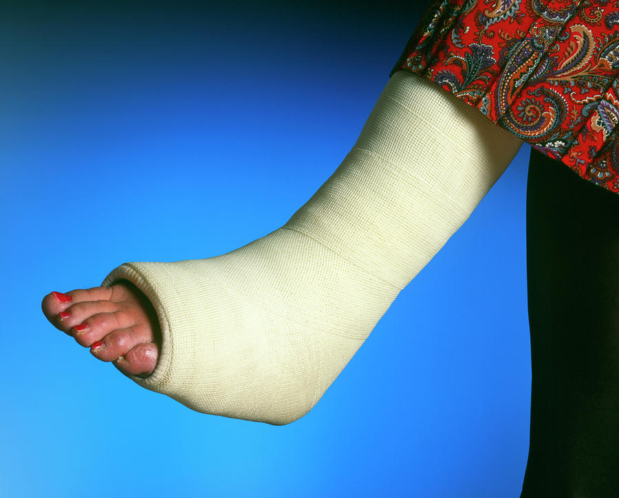 Plaster Cast On The Broken Leg Of A Woman Photograph by Simon Fraser/science Photo Library