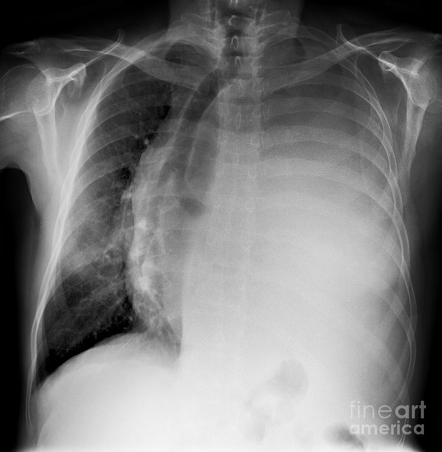 pleural effusion chest x ray