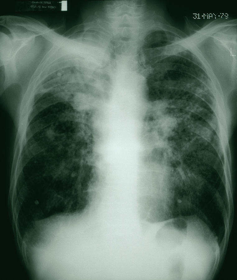 Pneumoconiosis Photograph by Steve Allen/science Photo Library | Pixels