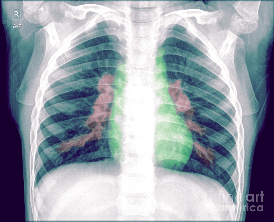 Pneumonia Photograph by Guy Viner