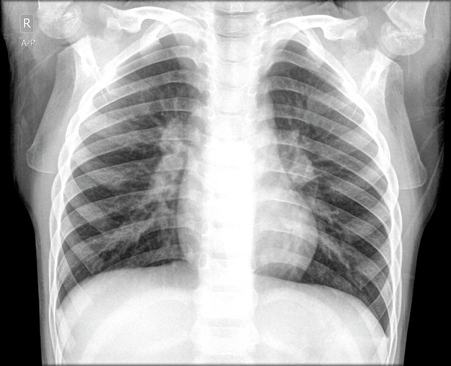 Pneumonia Photograph by Photostock-israel