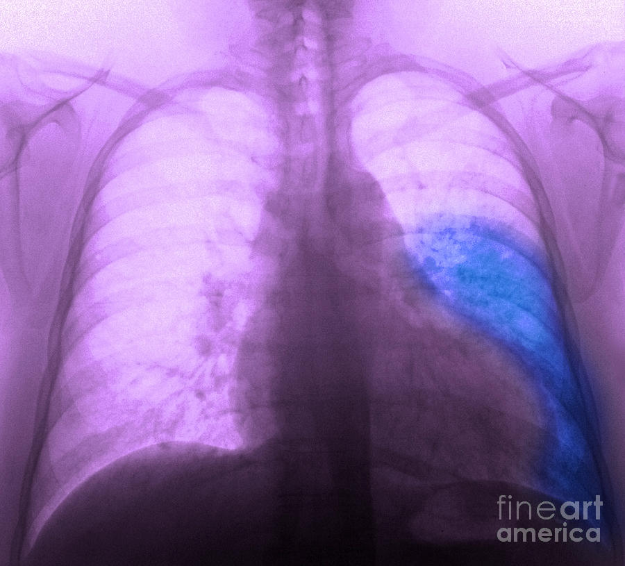 Pneumonia, X Ray Photograph by Scott Camazine