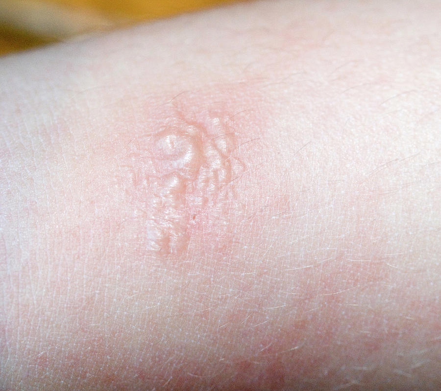 Poison Ivy Rash On Human Skin by Science Stock Photography/science ...