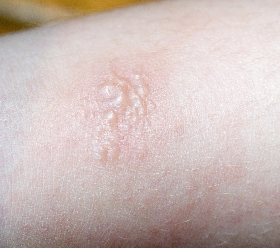 poison-ivy-rash-photograph-by-science-stock-photography