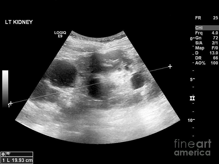 polycystic-kidney-ultrasound-scan-photograph-by-science-photo-library