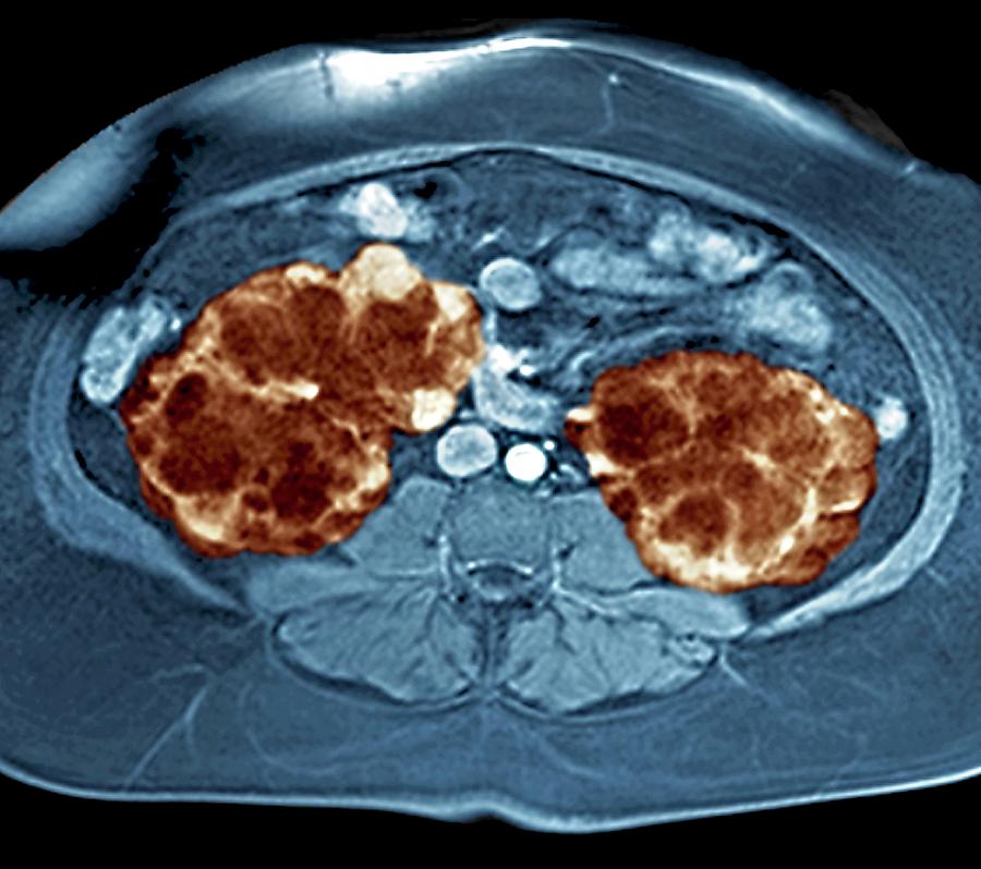 Polycystic Kidneys Photograph by Zephyr/science Photo Library - Fine ...