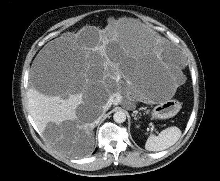 Polycystic Liver Disease Photograph by Gastrolab