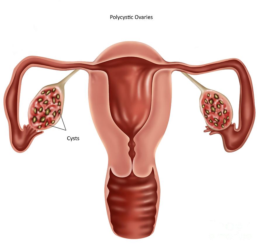 Polycystic Ovaries Photograph by Gwen Shockey