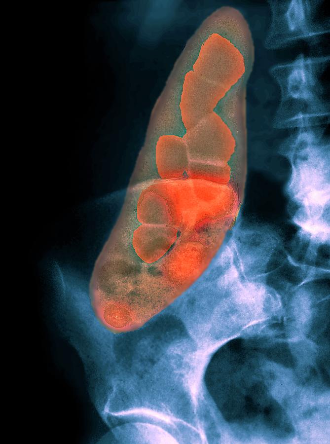Porcelain Gallbladder Photograph by Zephyr/science Photo Library