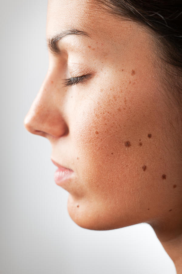 Portrait of a Woman with Melanoma Moles and Freckles (XXXL) Photograph by 4fr