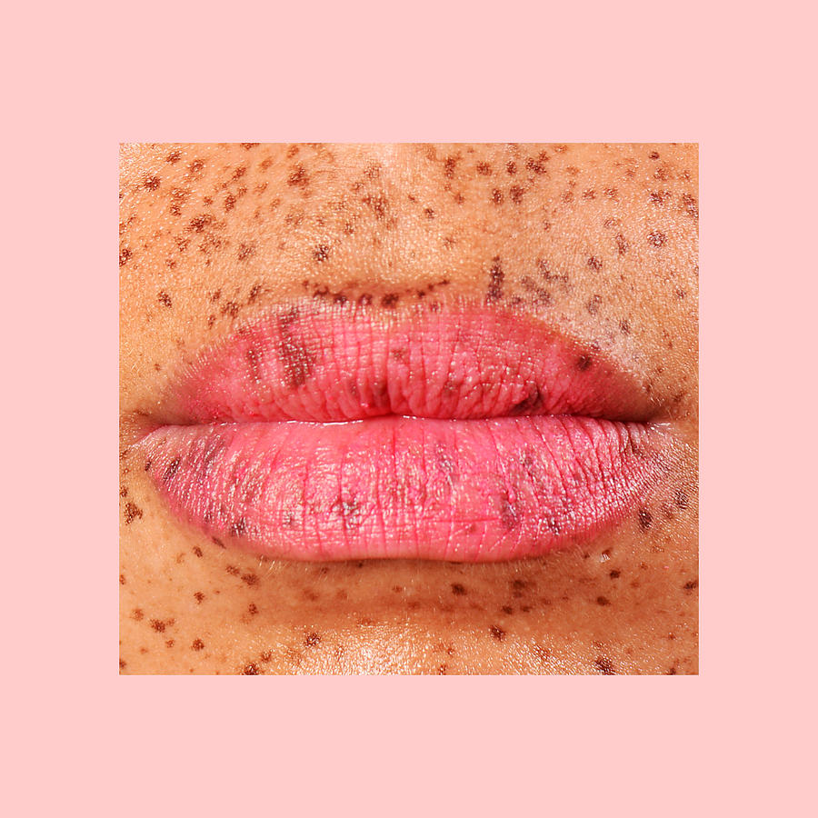 Portrait of Lips with Freckles Photograph by Rochelle Brock / Refinery29 for Getty Images
