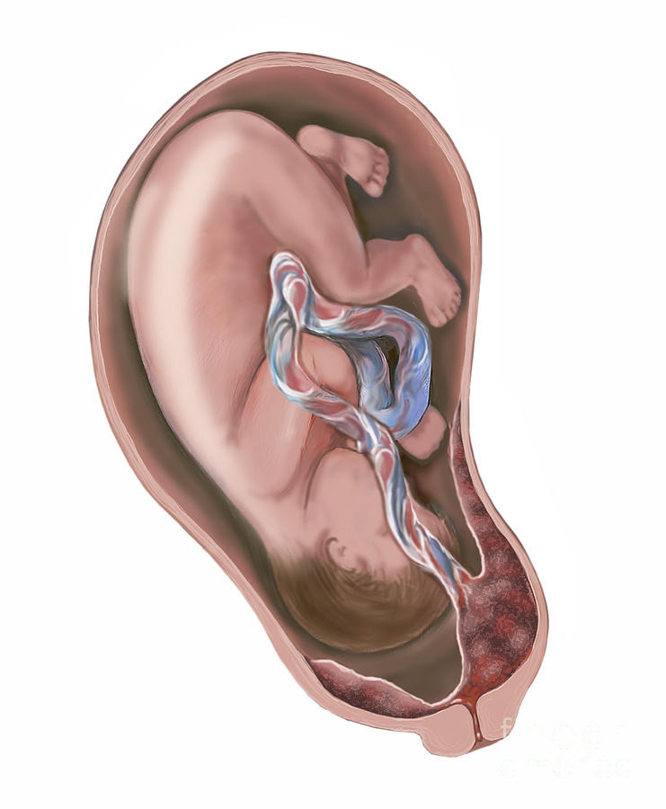 Vertical Digital Art - Pregnancy Complication, Placenta Previa by TriFocal Communications