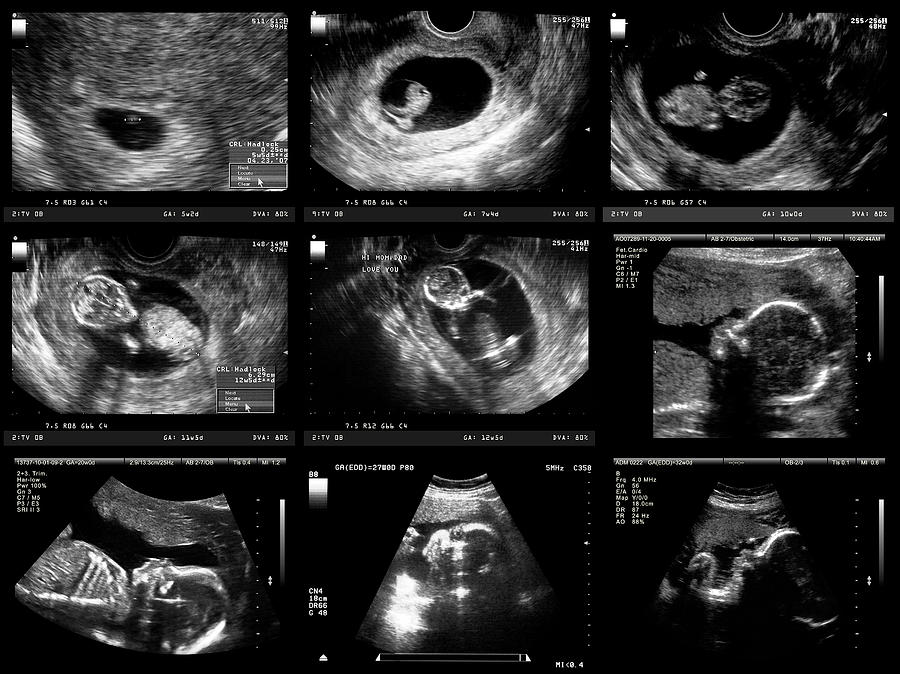 Pregnancy Ultrasound Photograph by UrsaHoogle