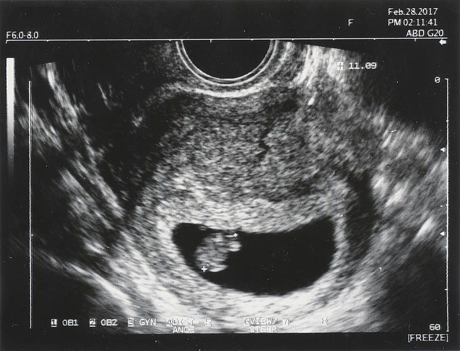 Pregnancy UltraSound Photograph by Yiming Chen