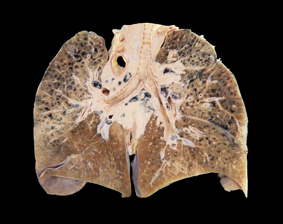 Primary Lung Cancer Photograph By Microscape Fine Art America